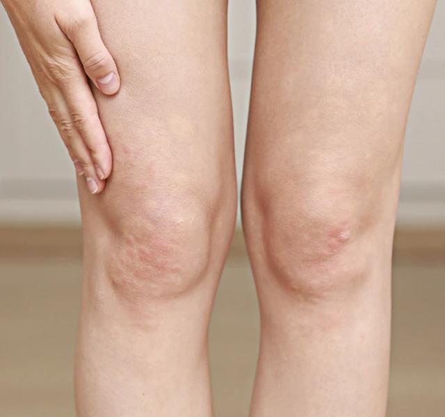 On Legs: Physical Friction and Misdiagnosis