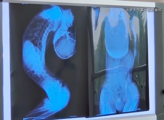 Ankylosing Spondylitis is a rare disease that has significantly impacted Jiang Yanchen's life