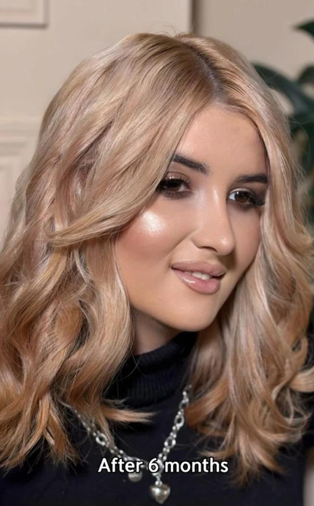 A close-up of the woman, now confident and happy with her post-surgery appearance, showcasing her new look.