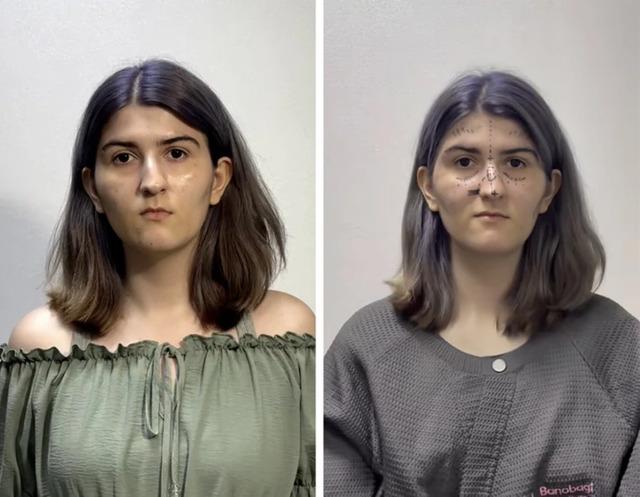 A comparison shot of the woman before and after surgery, highlighting her appearance change after undergoing cosmetic procedures in South Korea.