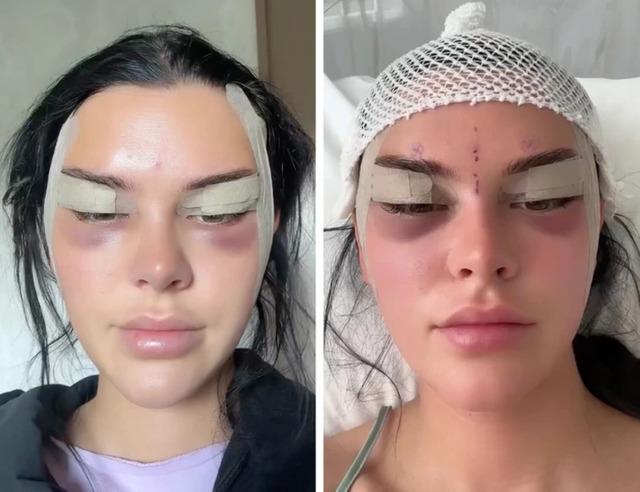 As Nelly filmed her journey, she was candid about the pain and swelling she experienced in the days following the surgery