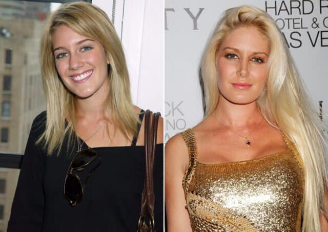 Heidi Montag’s dramatic transformation, the physical toll it took on her, and her complex feelings about her surgeries.