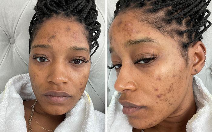 Keke Palmer: Sharing Her Struggles with PCOS and Skin Changes