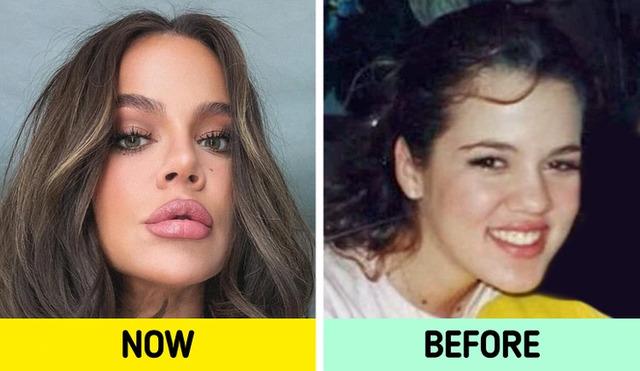Khloé Kardashian's transformation journey and her regret over cosmetic fillers.