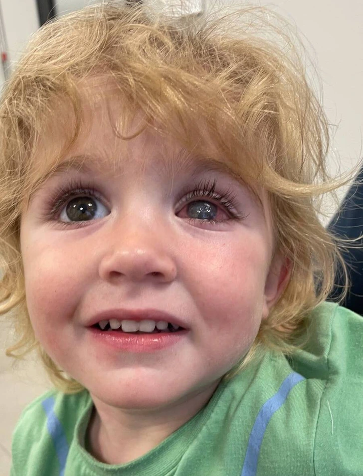 The toddler caught the virus from a kiss by someone with a cold sore, leading to a severe eye infection. While herpes is often linked to adults, HSV-1 can be more dangerous for babies due to their underdeveloped immune systems.