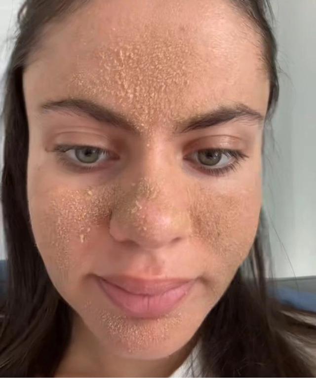 Close-up revealing thick, textured patches caused by the "Caveman" skincare approach.