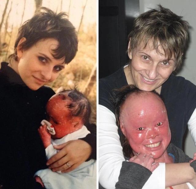 Diagnosed with a rare genetic skin disorder called Harlequin ichthyosis, Mui arrived in this world with skin so thick and red that her very survival was doubted
