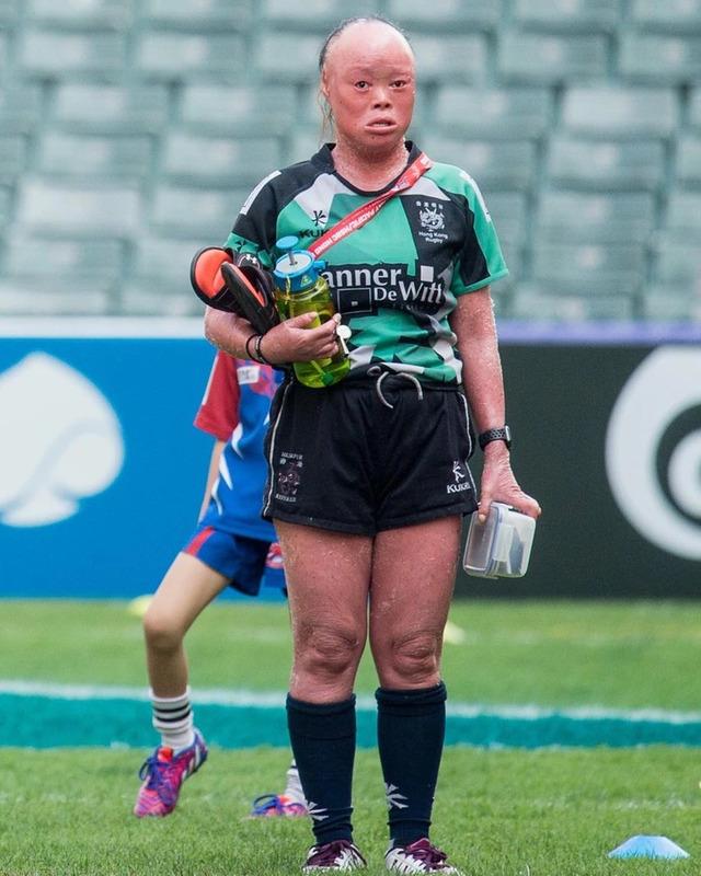 Inspired by her journey, Mui founded “The Girl Behind the Face,” a community platform designed to uplift and support individuals living with visible differences. 