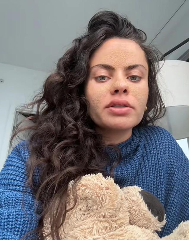 Tia Zakher showing early signs of dry, flaky skin after stopping all face washing.