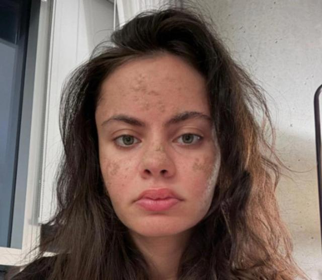 Visible buildup of dead skin cells highlighting the effects of no cleansing over several weeks.