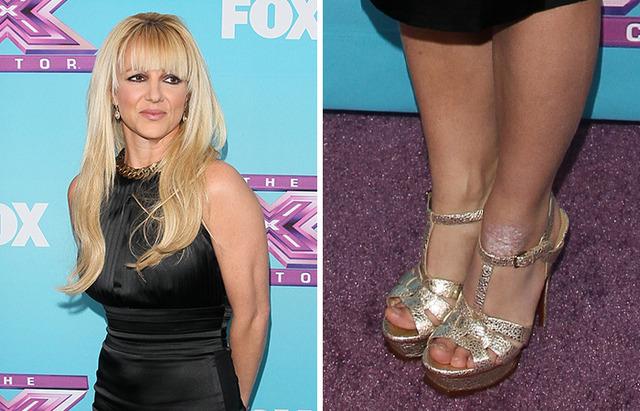 Britney Spears and Psoriasis: The Hidden Battle Behind the Spotlight