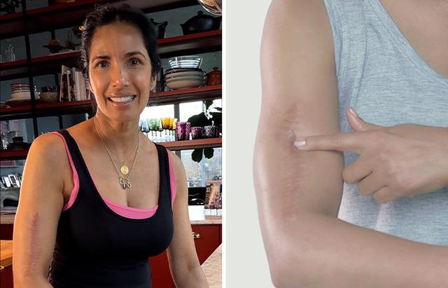 Padma Lakshmi’s Arm Scar: Embracing a Mark of Survival