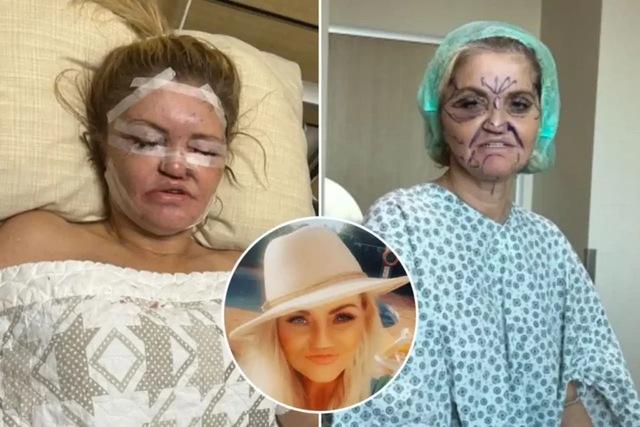 At the heart of her transformation was a surgical thread lift, an innovative technique involving the insertion of 1,200 threads across the face