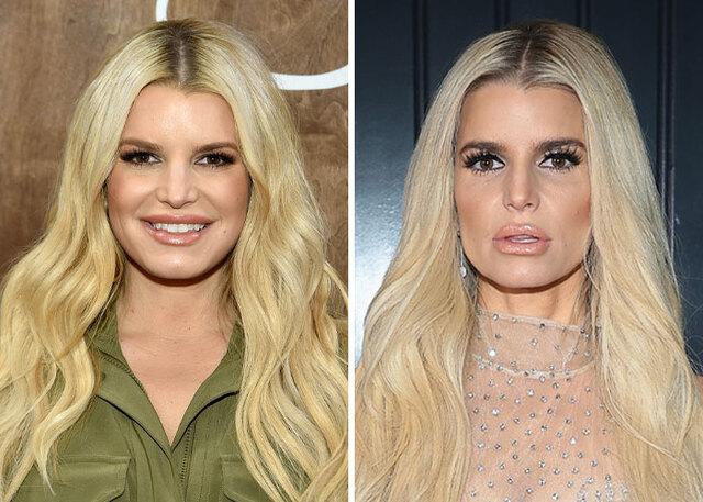 Dry skin, sunken eyes and wrinkles: the effects of Ozempic in Jessica Simpson