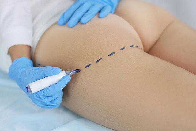Medical professionals marking the precise areas involved in a Brazilian Butt Lift procedure.