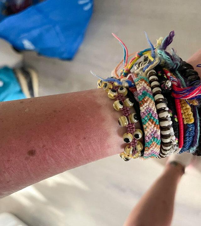 Bracelet Tan Line as an Accidental Tattoo