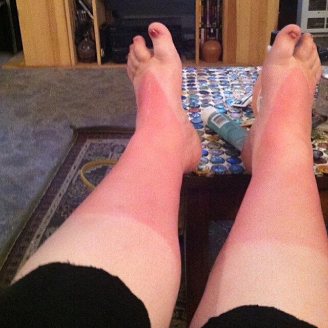 Burn From Years Ago Still Remembered