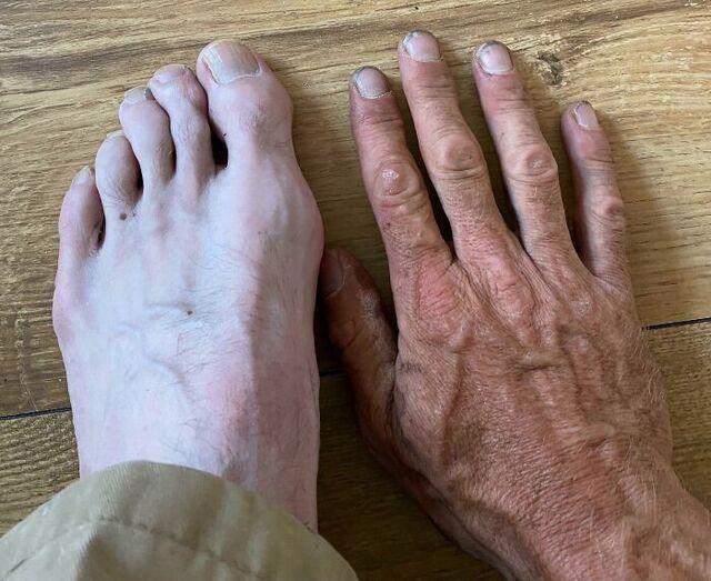 Drastic Color Difference Between Hand and Foot