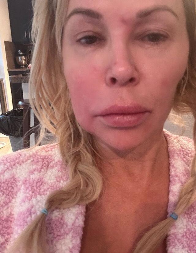 Early signs of trouble: Brandi shared a raw selfie showing her face red and inflamed after applying hair remover.