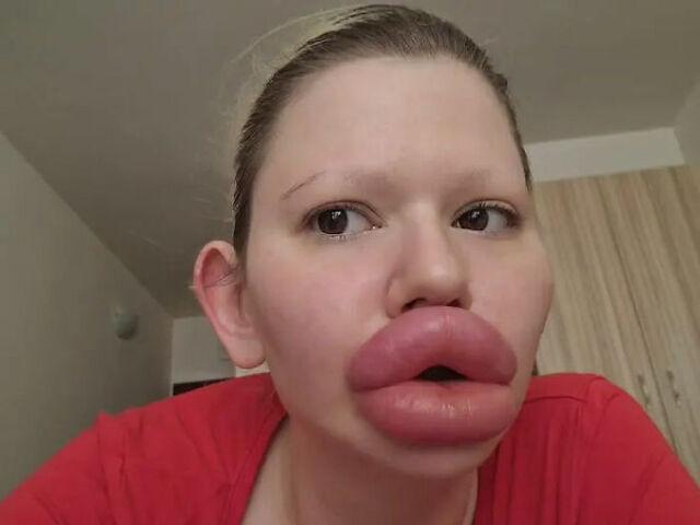 Her dedication to extreme lip fillers has made her a global phenomenon, with lips now several times larger than before..