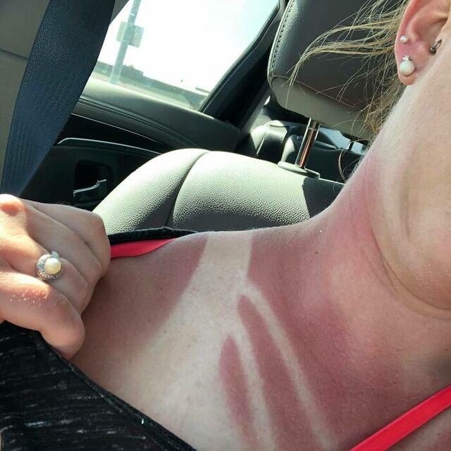 Husker Day Burns That Hurt Too Much