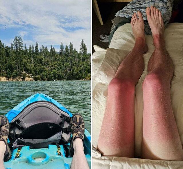 Kayak Trip Without Sunscreen on Legs