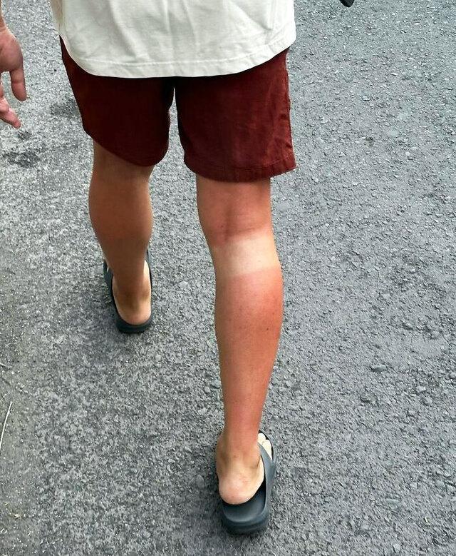 Knee Brace Creates Painful Burn Pattern