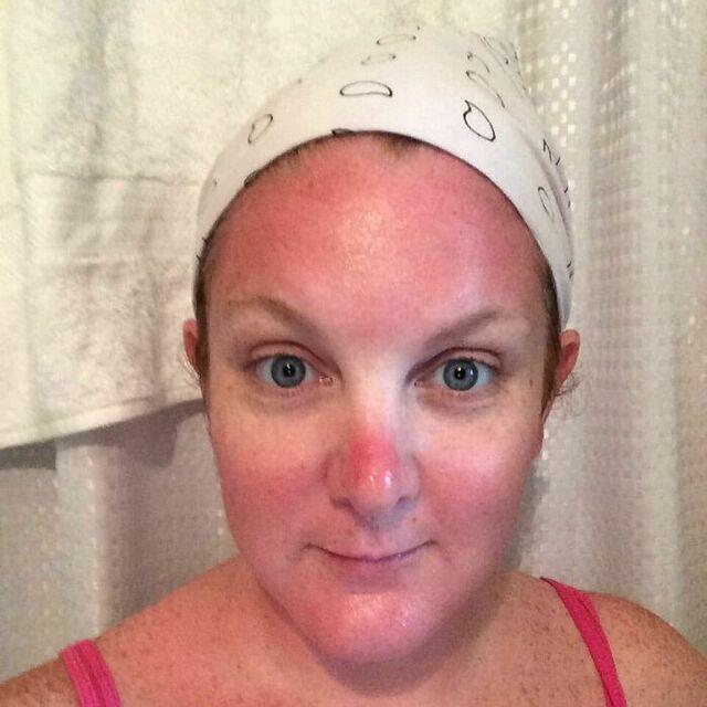 Losing Sunscreen Means Expensive Painful Lesson