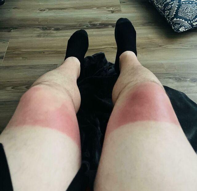 Missed Sunscreen During Honeymoon Glow