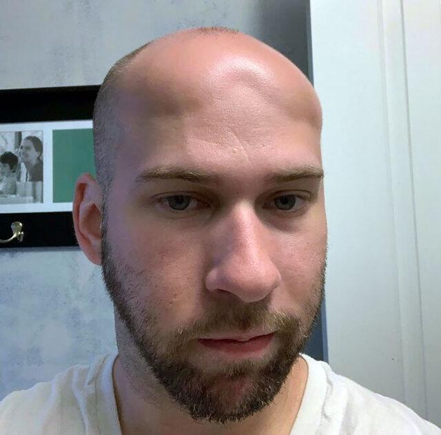 Severe Sunburn Causing Scalp Edema