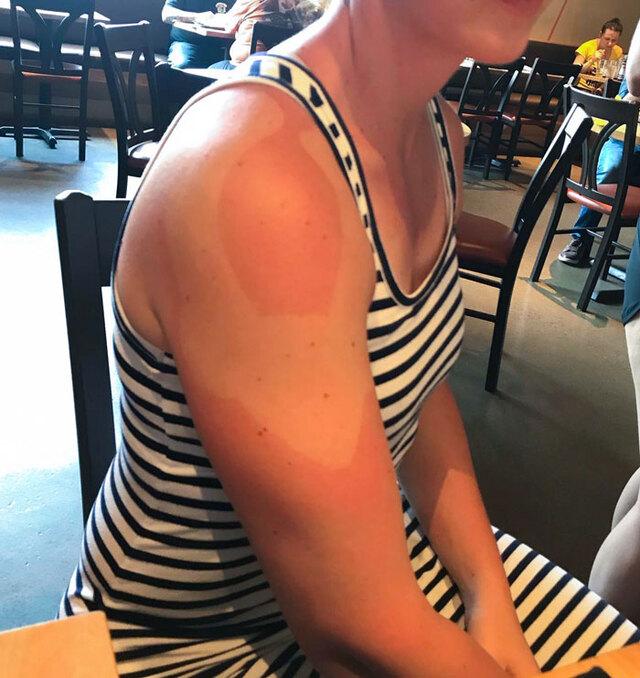 Shoulder Tape Burn Disaster After Injury Care