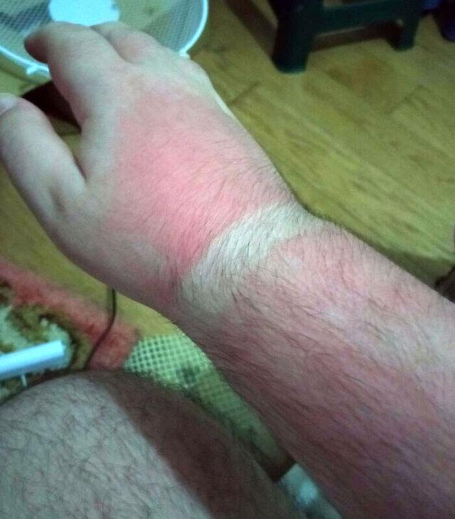 Strongest Sunscreen but Still Burnt Pale Skin