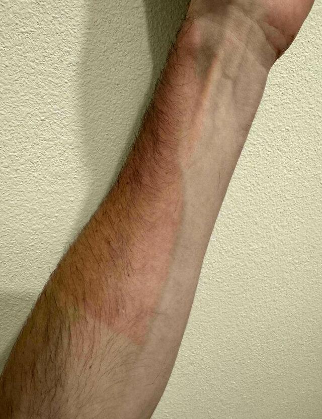 Sunburn Line That Perfectly Followed a Vein
