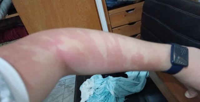 Sunscreen Wiped on Arm Instead of Everywhere