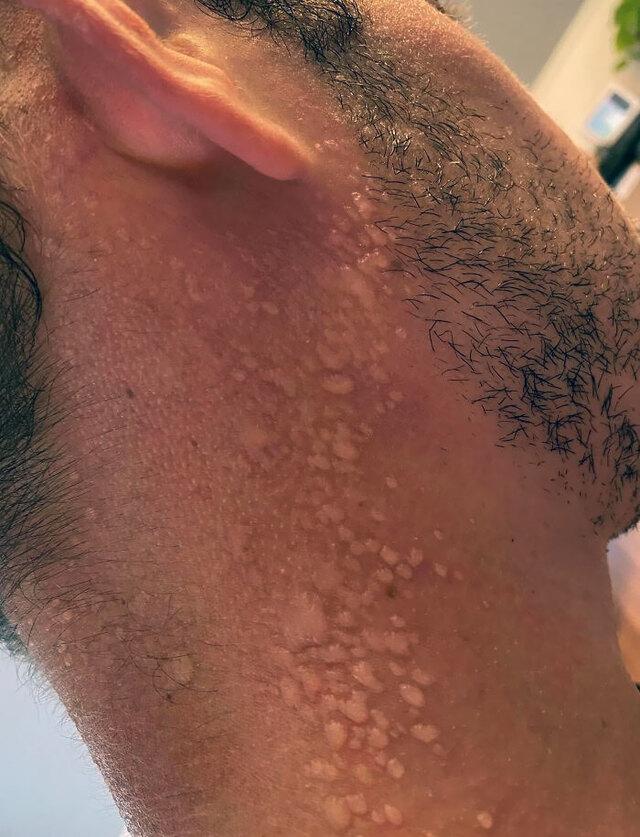 Sweat Bubbles Forming Under Peeling Skin