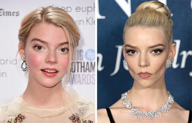 Anya Taylor-Joy: The Poster Girl for Buccal Fat Removal Speculation