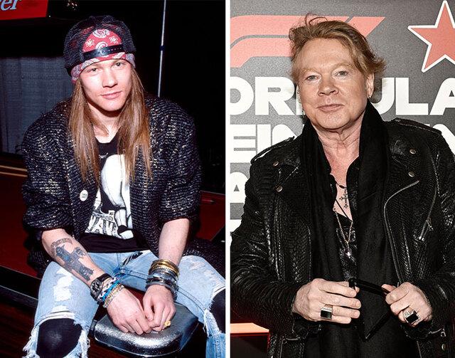Axl Rose, once the gritty face of Guns N’ Roses, shocked fans when his smooth, fuller look suggested heavy reliance on cosmetic procedures.