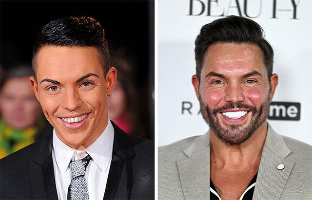 Bobby Norris: An Open Admission of Buccal Fat Removal