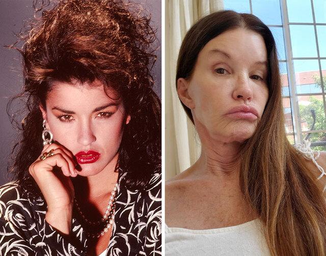 Janice Dickinson, hailed as the world’s first supermodel, spoke openly about her many procedures, making her one of the most candid voices in the industry.