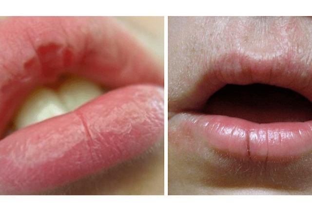 Cracked Lips That Won’t Heal: More Than Just Dry Weather