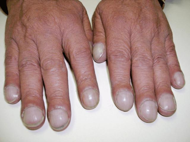 Curved or Clubbed Fingernails: The Shape That Speaks Volumes