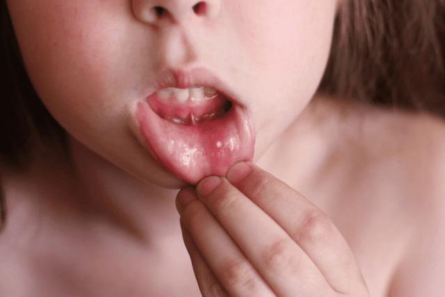 Frequent Mouth Sores or Ulcers: A Painful Signal