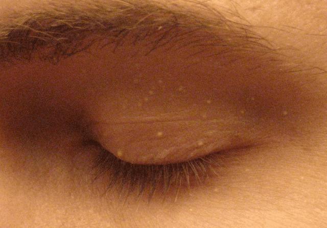 Small White Bumps Near Eyelids: Tiny but Telling