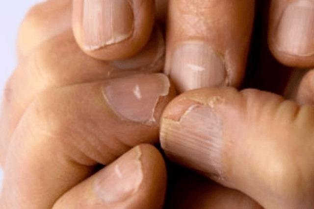 White Spots on Nails: Small Marks with Big Meaning