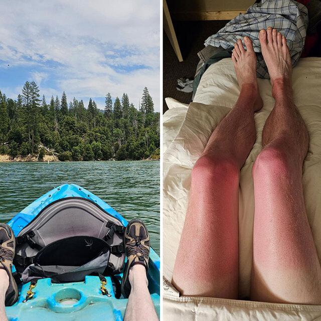 A kayaking trip ruined by forgotten sunblock.