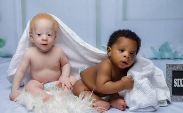 As doctors explained, David’s pale skin and golden curls were the result of a rare genetic condition called oculocutaneous albinism