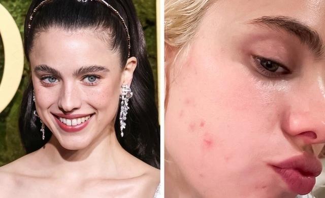 Margaret Qualley suffered chronic skin damage after a year in prosthetics.