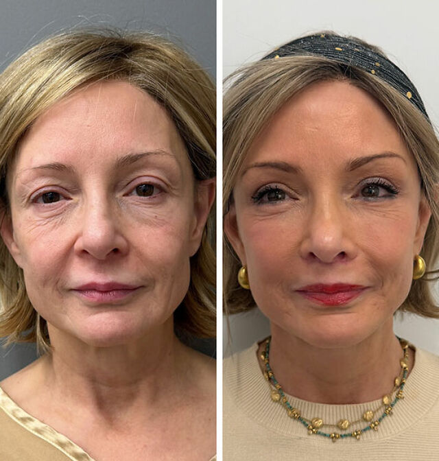 Focusing on the eyes and brow: Correcting years of aging while maintaining the patient’s unique character.