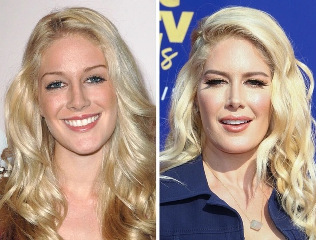 Heidi Montag’s journey serves as a powerful and sobering cautionary tale about the intense pressures of reality TV stardom.