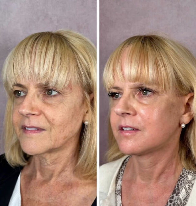 Side-by-side comparison showing the elimination of sagging skin and restoration of mid-face volume.